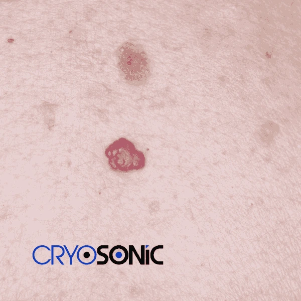 Looking for pain free cherry angioma removal treatment Durham? Call our team today! Durham