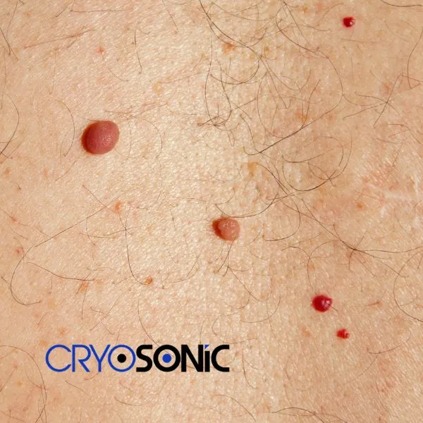 get cherry angioma removal treatment today! Durham