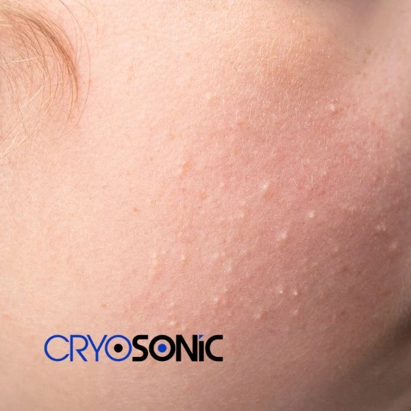 Are you looking for milia removal treatment? Contact our team today Durham