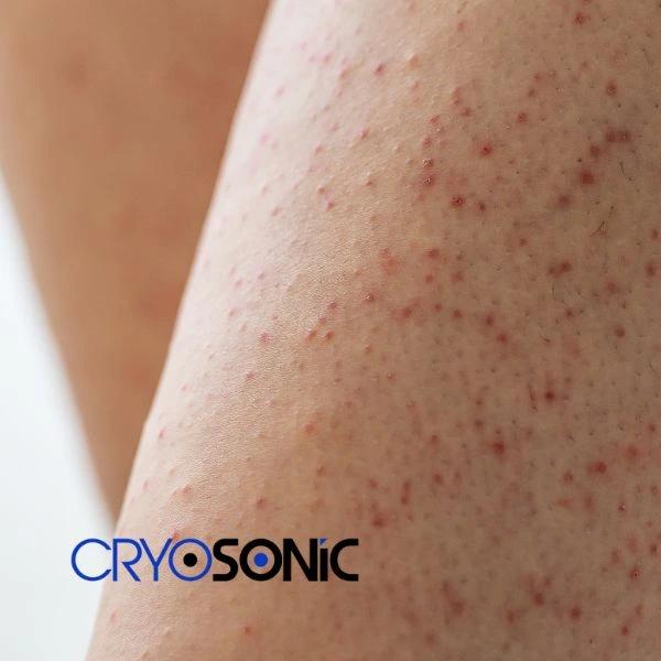 Looking for Seborrhoeic Keratosis removal Durham treatment? Call our consultants today in Durham