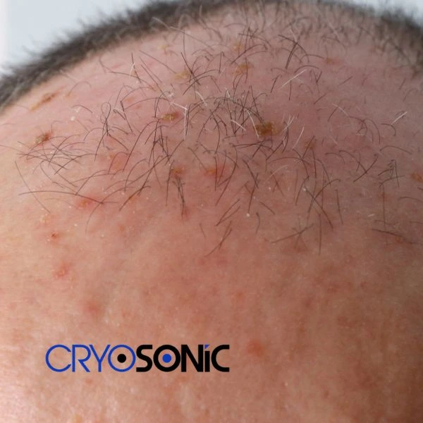 Access Seborrhoeic Keratosis removal from the comfort of your own home! Call us today in Durham