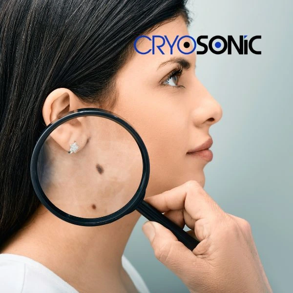Do you want to learn more about benign moles removal treatment? Call our team today Durham