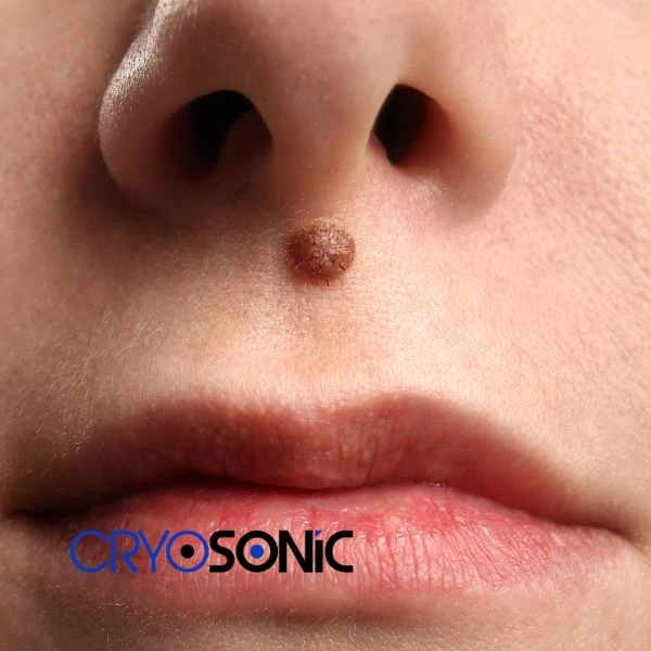 Start your benign moles removal treatment today Durham