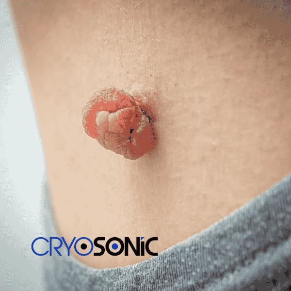 Book your skin tags removal Durham from comfort of your own home! Durham