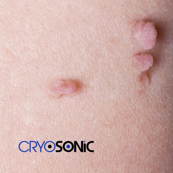 Are you looking for fast effect skin tag removal Durham? Book in NOW! Durham