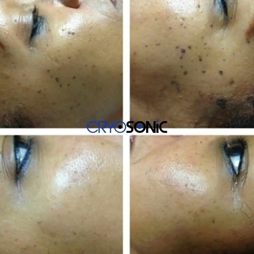 Why Skin Shows Pigmentation After Treatment Durham